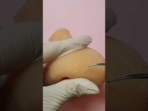 big nose blackhead removal ASMR   #relax  #shorts