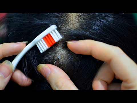 ASMR Scalp Check / Big Flakes / Toothbrush / Scratching / Combing Relax For Sleep