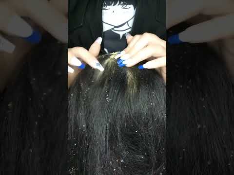 Dandruff Removal 💆🏻‍♀️😱 #asmr #relax #visualtingle #satisfying #relaxing #tingles #canada#shorts