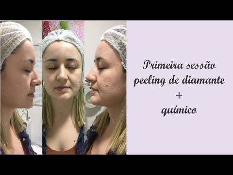 MINHA PRIMEIRA SESSÃO DE PEELING DE DIAMANTE + QUÍMICO