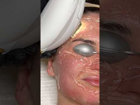 ASMR Laser Treatment