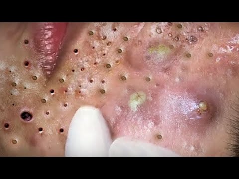 SATISFYING AND RELAXING PIMPLE POP COMPILATION | PART 30