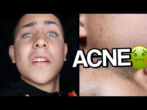 Combatendo CRAVOS e ESPINHAS sem ROACUTAN - TRATA ACNE #1