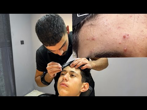 Ad-free Blackhead acne treatment and skin care