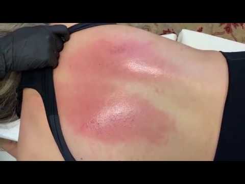 EXTREME CHIROPRACTIC CRACKS Fixes FROZEN SHOULDER AND NECK!