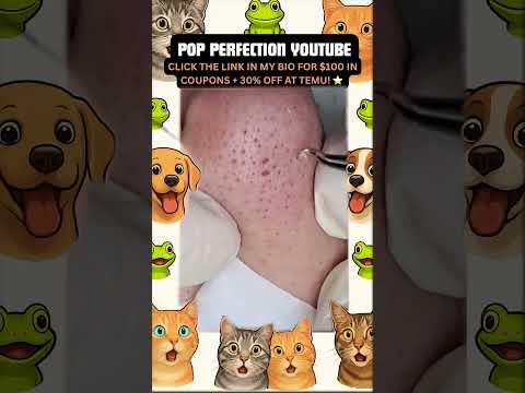 Wow! #pimpleremoval #pimple #pimples #shortsfeed #shortvideo #shorts #short #youtube #youtubeshorts