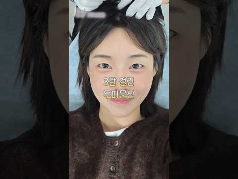 정수리 휑해서 3달에 걸쳐 두피문신 받아봤어
