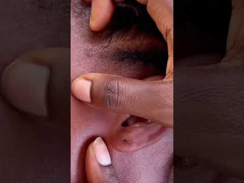Asmr ear hole nitpicking #relax #asmr #pimplepopper #blackheadsremoval