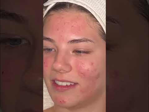 Huge Pimple Extraction: Celebrity Tears and a New Friend! #shorts