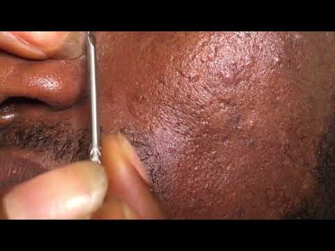 Asmr - real person satisfying nitpicking. #asmr #satisfying