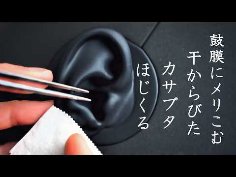 【ASMR KU100 無言】鼓膜にメリこむカサブタをジワジワ奥へほじくって干からびたパリパリ衣をつまんでポイ。なシチュエーション的耳掃除｜Digging Out a Dry, Crusty Scab