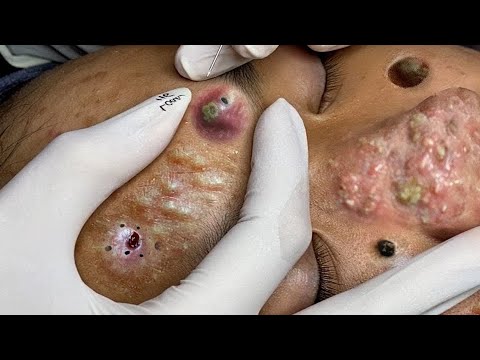 SATISFYING AND RELAXING PIMPLE POP COMPILATION | PART 25