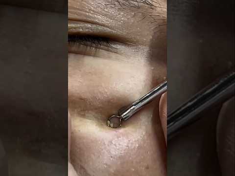 Black spots with two adult individuals #acne #barber #asmr