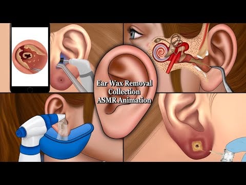 Hard Ear Wax Removal and Ear Care ASMR Animation Compilation, Satisfying Ear Cleaning ASMR Animation