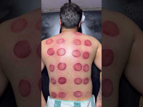 "asmr pizza cupping"Healing Through Cupping Therapy#cupping #asmr #pizza #shorts #trendingshorts