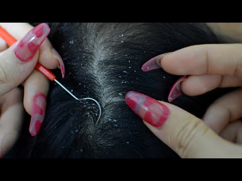 Asmr Relaxing Scalp Check, Scalp Picking, Scalp Scratching For Sleep ( No Talking )
