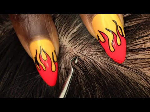 ASMR Upclose Attentive Nitpicking Whiteheads for sound sleep 😴