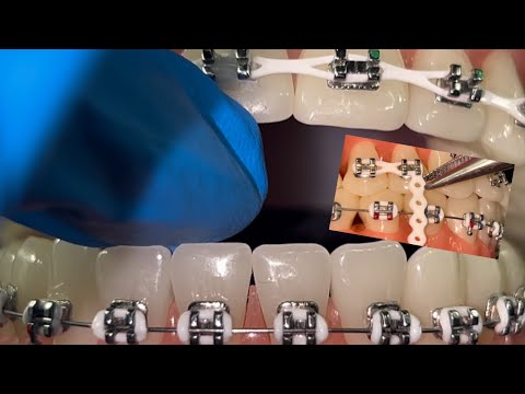 ASMR DOCTOR POV ROLEPLAY: THE WORST Orthodontist Adjusts Your Braces (LoFi) 