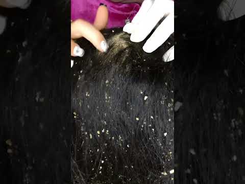 ASMR Dandruff Removal And Cleaning 💆🏻‍♀️🍪 #asmr #satisfying #visualtingle #relaxing #shorts