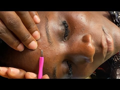 ASMR FACE PICKING AND CLEANING, SLEEP NITPICKING, SATISFYING TINGLES WITH GUM CHEWING