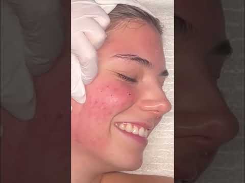 Satisfying Pimple Popping: Names, Sizes, and 'Good Stuff'! #shorts
