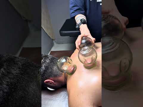 asmr cupping❤️😍#cupping #shorts #youtubeshorts #cuppingtherapy #viral