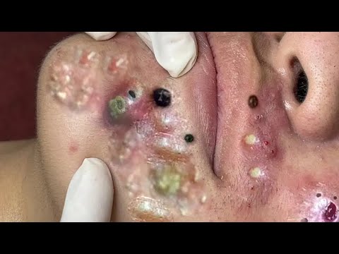SATISFYING AND RELAXING PIMPLE POP COMPILATION | PART 20