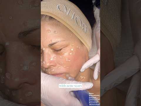 ASMR Microneedling