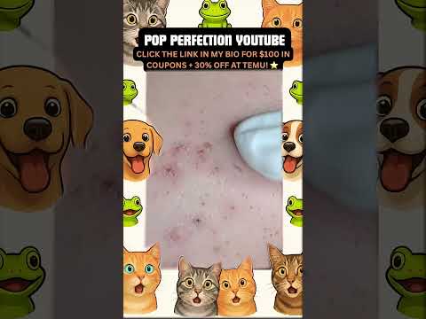 Wow! #pimpleremoval #pimple #pimples #shortsfeed #shortvideo #shorts #short #youtube #youtubeshorts