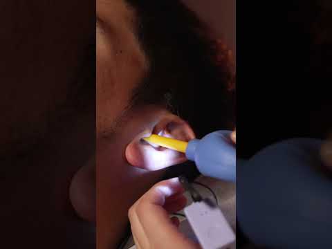 ASMR Satisfying Ear Shampoo and Ear Shower with Bebird Earsight Plus #earcleaning #asmr #earwax