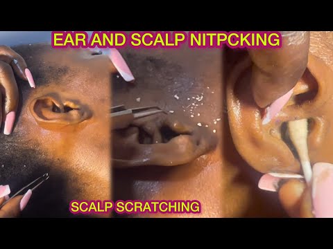ASMR, UPCLOSE SCALP NITPICKING  WHITE HEADS AND SCRATCHES WITH DIRTY EAR CLEANING