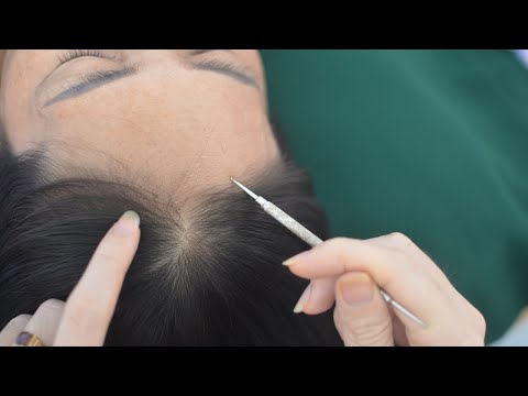 ASMR Real Person Head Tingles ( Head Scratching, Hair Parting ) Sounds For Anxiety Relief