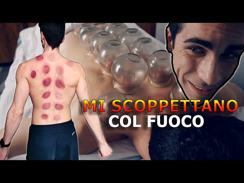 HO PROVATO la TERAPIA di COPPETTAZIONE COL FUOCO in Cina! (Cupping therapy cinese)