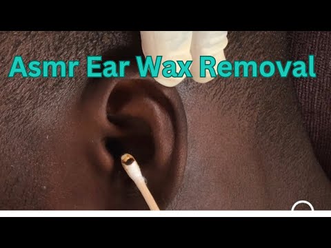 Asmr Ear Wax and removal #earwaxremoval #earcleaningasmr #nitpicking