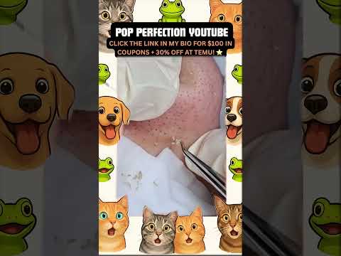 Wow! #pimpleremoval #pimple #pimples #shortsfeed #shortvideo #shorts #short #youtube #youtubeshorts