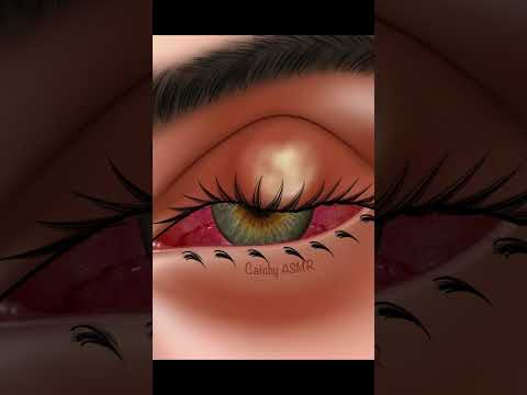 Relaxing Eye Infection Cleaning ASMR Animation, Satisfying Eye Treatment ASMR Animation