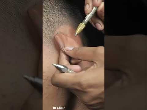 Satisfying Pin Pen Head Massage With Crunchy Neck Crack And Ear Crack ASMR #shorts