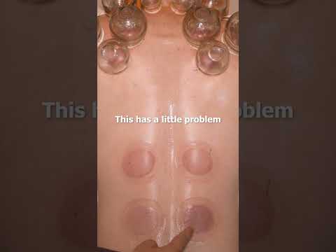 ASMR: Chinese Chiropractic and Cupping Fixes my Neck and Back Pain! #shorts