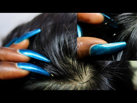 ASMR Allzoomed Full Head Scalp Nitpicking Whiteheads 1HR 🤯.