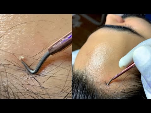 {ASMR} 6x Zoomed Extracting Face whiteheads with new tool ~ soo satisfying