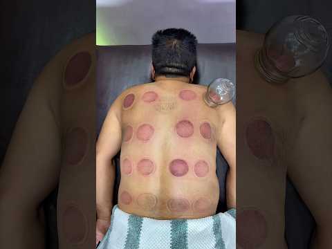 ASMR Vip Cupping | Alinezhad😍#shorts #viral #fyp #asmr #asmrsounds #cupping