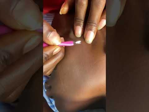 ASMR FACE NITPICKING EAR CLEANING, SCALP SCRATCHING GUM CHEWING