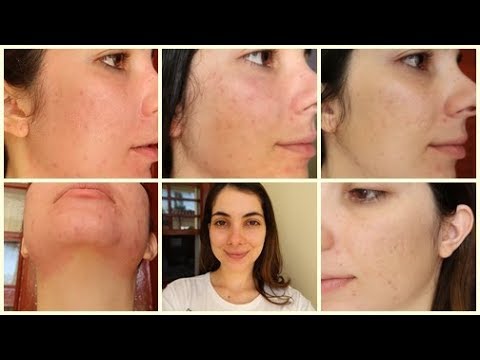 DIÁRIO DO LASER DE CO2 NAS CICATRIZES DE ACNE (Segunda sessão)