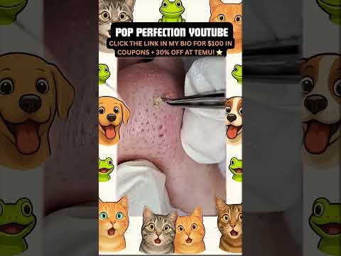 Wow! #pimpleremoval #pimple #pimples #shortsfeed #shortvideo #shorts #short #youtube #youtubeshorts