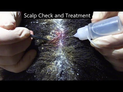 ASMR Scalp Check and Treatment (Dandruff Removal, Whispering, Scalp Massage, Medical Instruments)