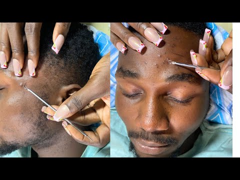 ASMR FACE NITPICKING AND MASSAGE FOR RELAXATION- BUBBLEGUM