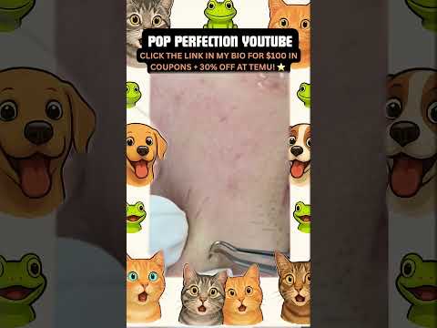 Wow! #pimpleremoval #pimple #pimples #shortsfeed #shortvideo #shorts #short #youtube #youtubeshorts