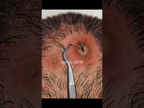 Flaky Scalp cleaning ASMR Animation, Relaxing Dandruff Removal and Hair Makeover ASMR Animation