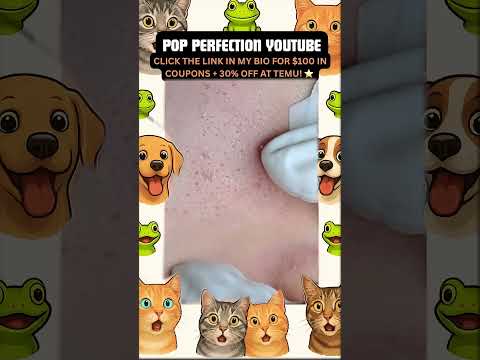 Wow! #pimpleremoval #pimple #pimples #shortsfeed #shortvideo #shorts #short #youtube #youtubeshorts
