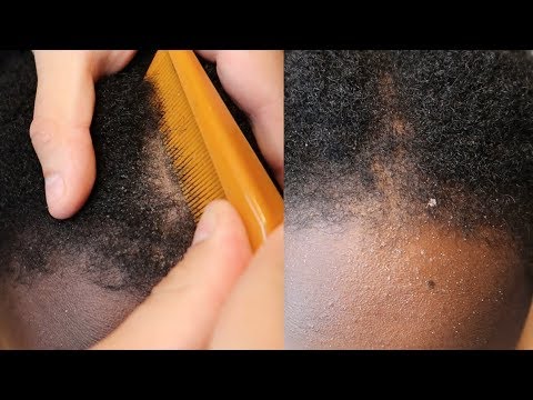 ASMR INTENSE scalp Scratching Flakes (4c hair brushing)